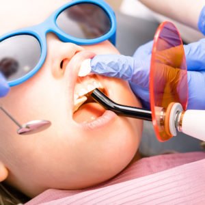 Dental Fillings (Restorations)