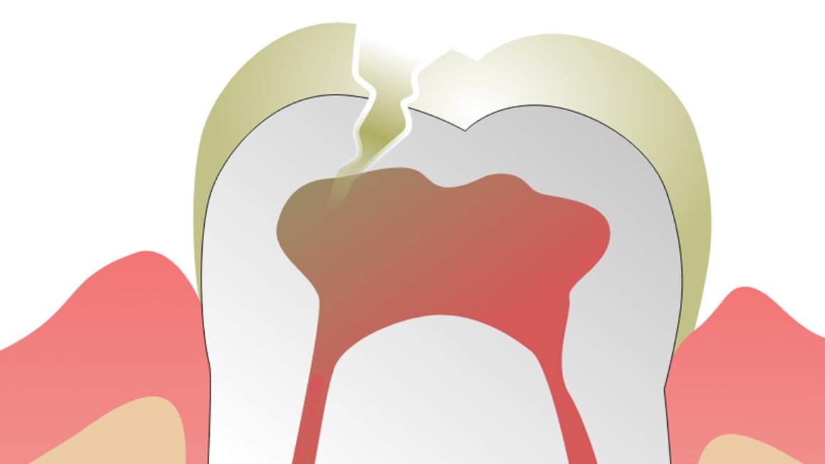 Dental Fillings (Restorations)