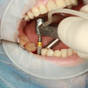 A Basic Guide to Dental Implants and What to Expect